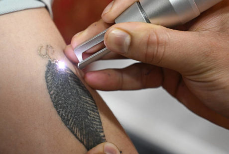 détatouage laser