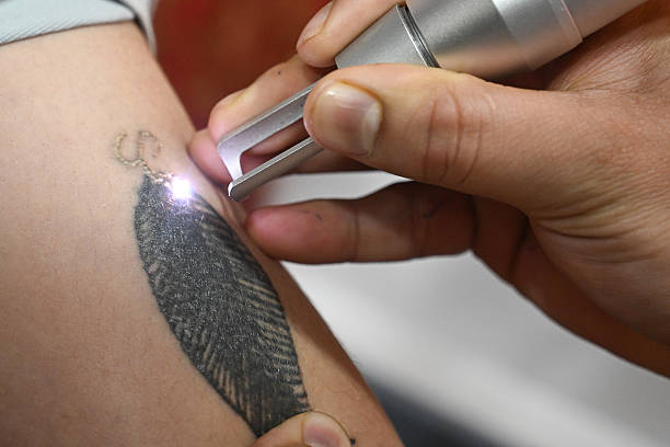 détatouage laser